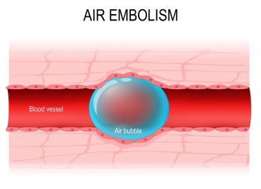 Usuwanie wkłucia centralnego a zatorowość płucna (zator powietrzny)
